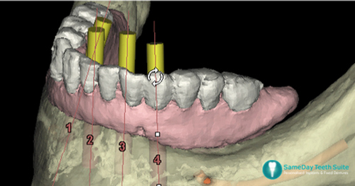 How to Do Accurate Dental Implants - image