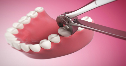 Tooth Extraction Before Having Implants or Dentures Fitted - image
